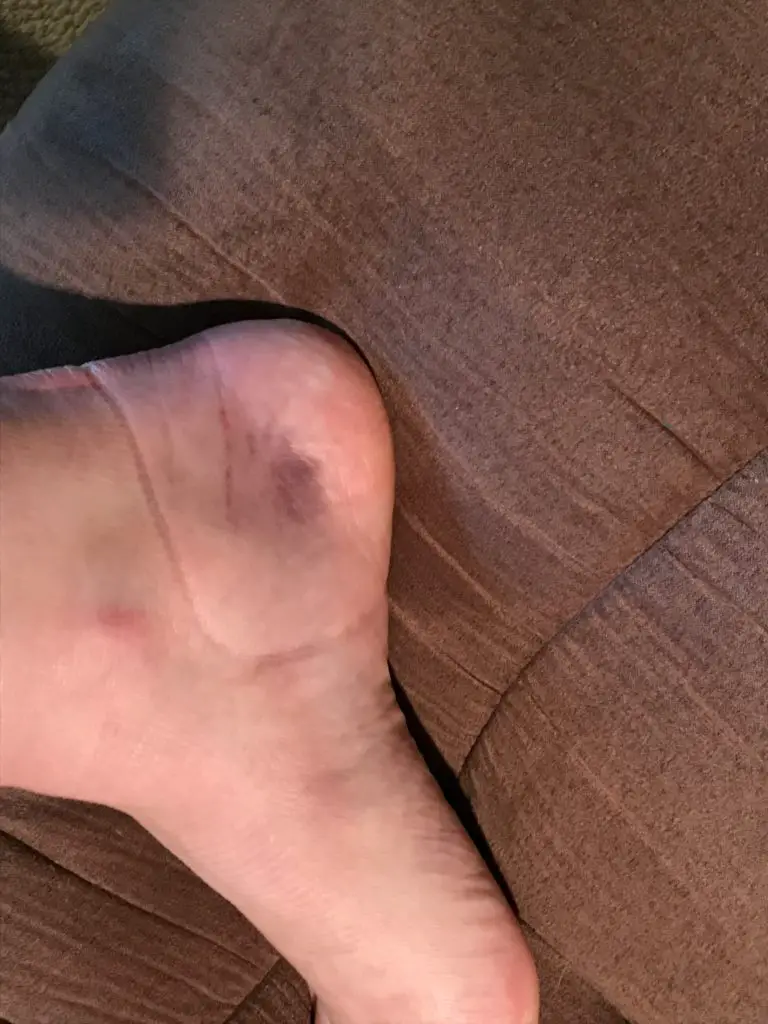 Bruise on inner ankle